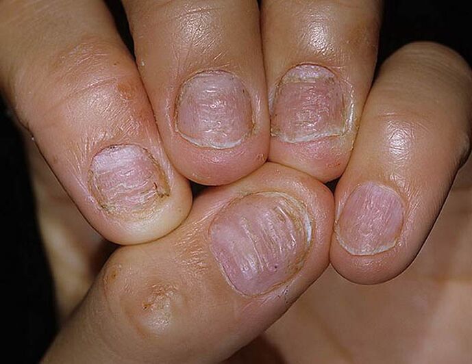 Psoríase das uñas