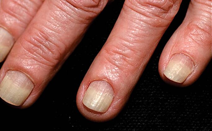 Extensión da onicolise dende o bordo da unha ata o pregamento das uñas