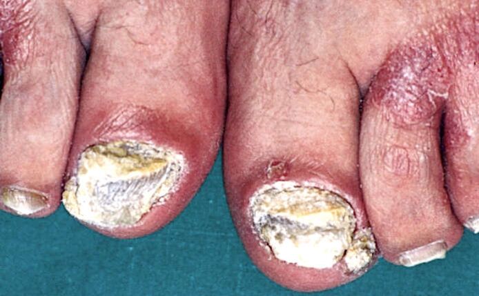 Hiperqueratosis subungual grave e placas psoriásicas nos dedos dos pés