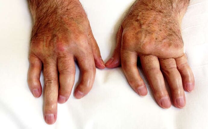 Mutilación da artrite na psoríase