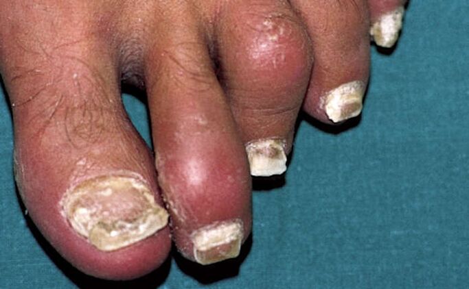 Psoríase con afectación das uñas e inflamación das articulacións (artrite) dos dedos dos pés