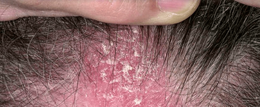 Lesións cutáneas no coiro cabeludo con psoríase